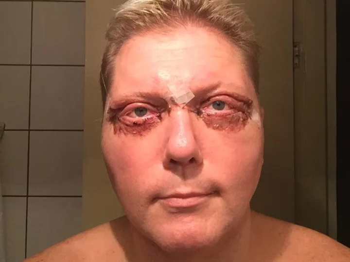 Vesa Keskinen silmät ja leikkaus selitettynä