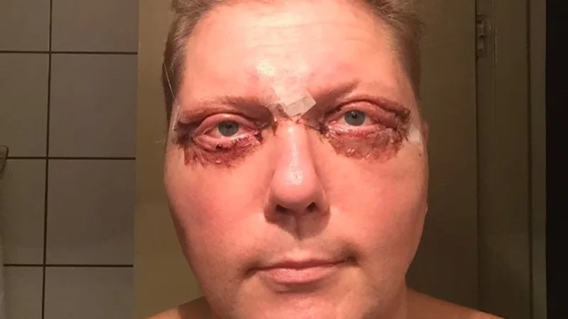 Vesa Keskinen silmät ja leikkaus selitettynä