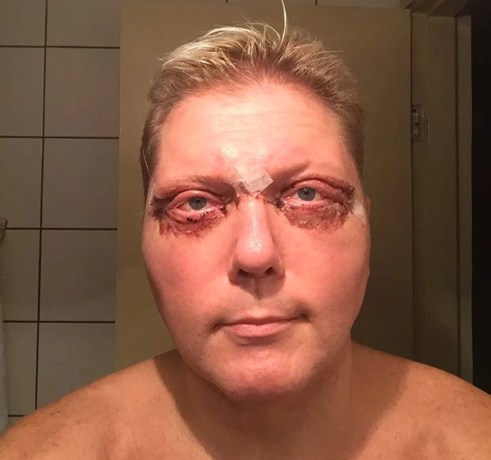 Vesa Keskinen silmät ja leikkaus selitettynä